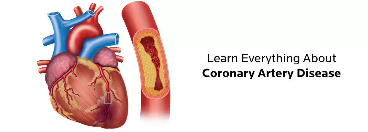 Learn Everything About Coronary Artery Disease
