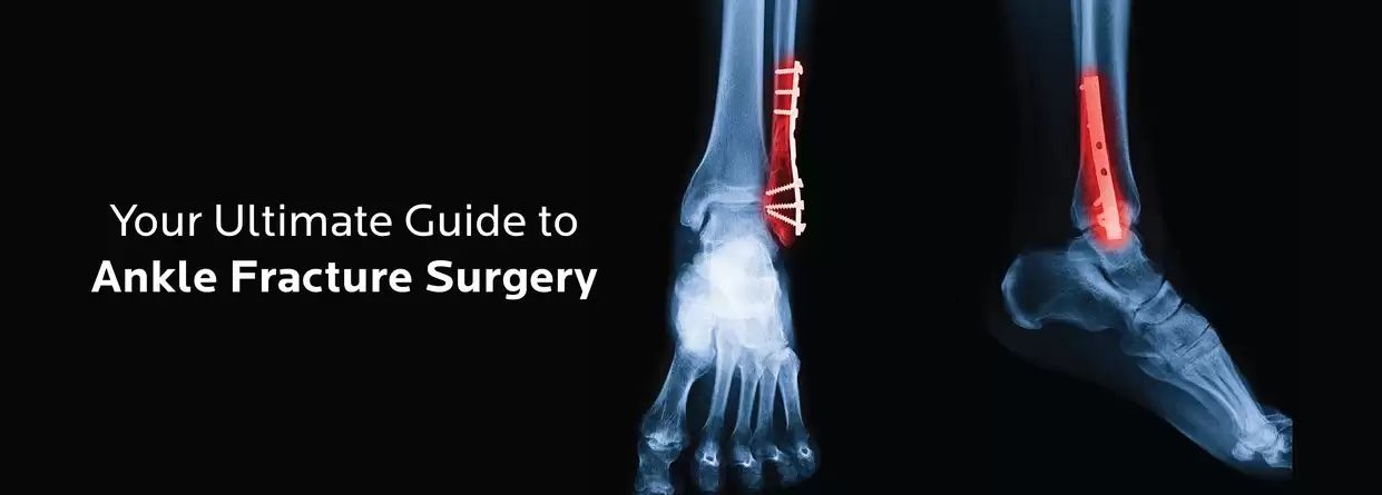 Your Ultimate Guide to Ankle Fracture Surgery