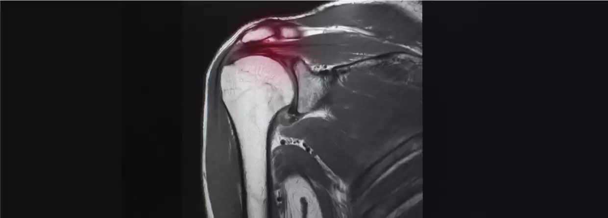 Know All About Frozen Shoulder Surgery