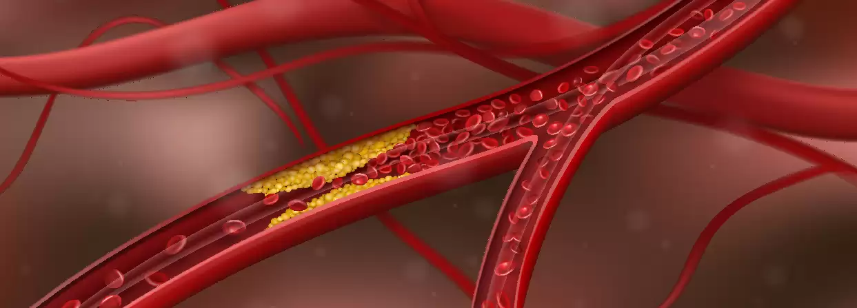 Common Coronary Artery Diseases and their Causes