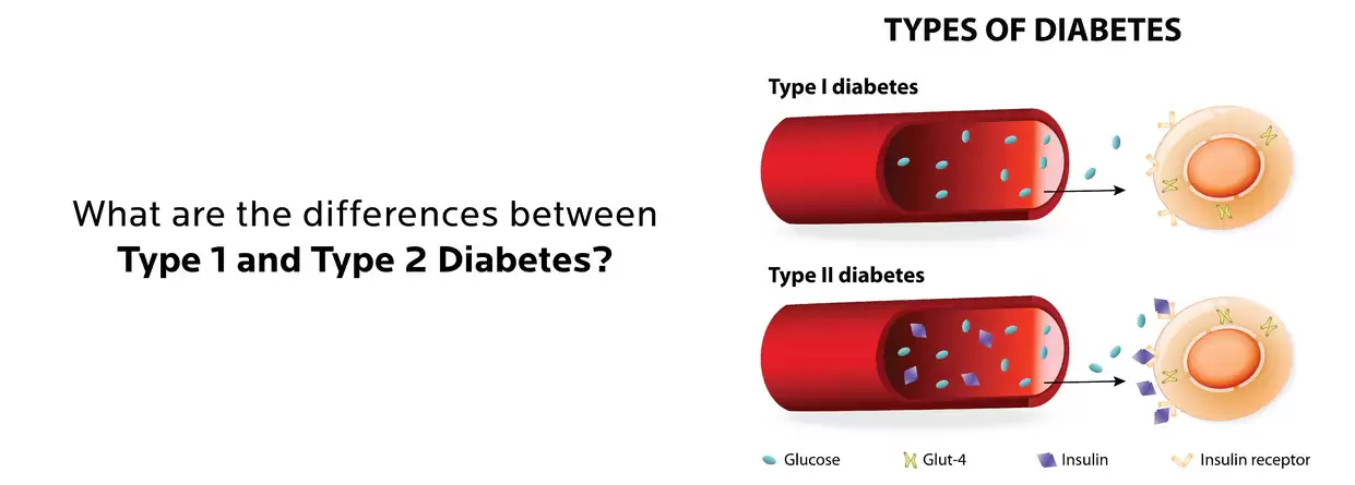 What are the differences between type 1 and type 2 diabetes?