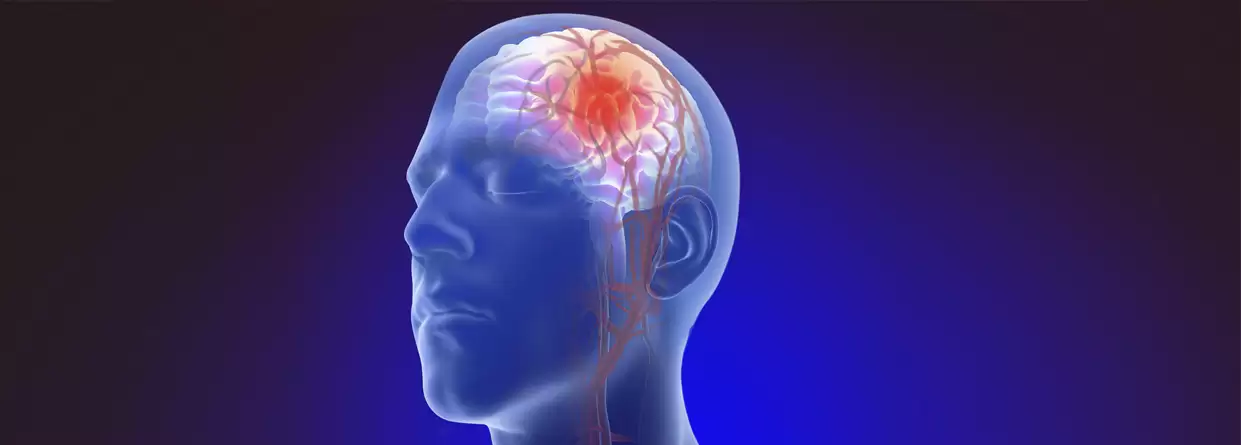 Brain Aneurysm - Symptoms And Causes