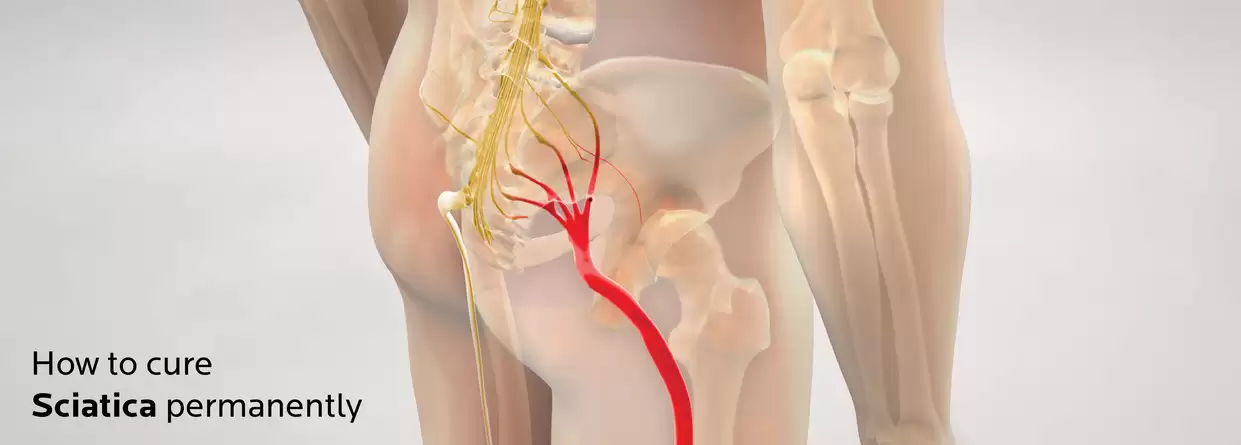 What Do You Need to Know About Sciatica?