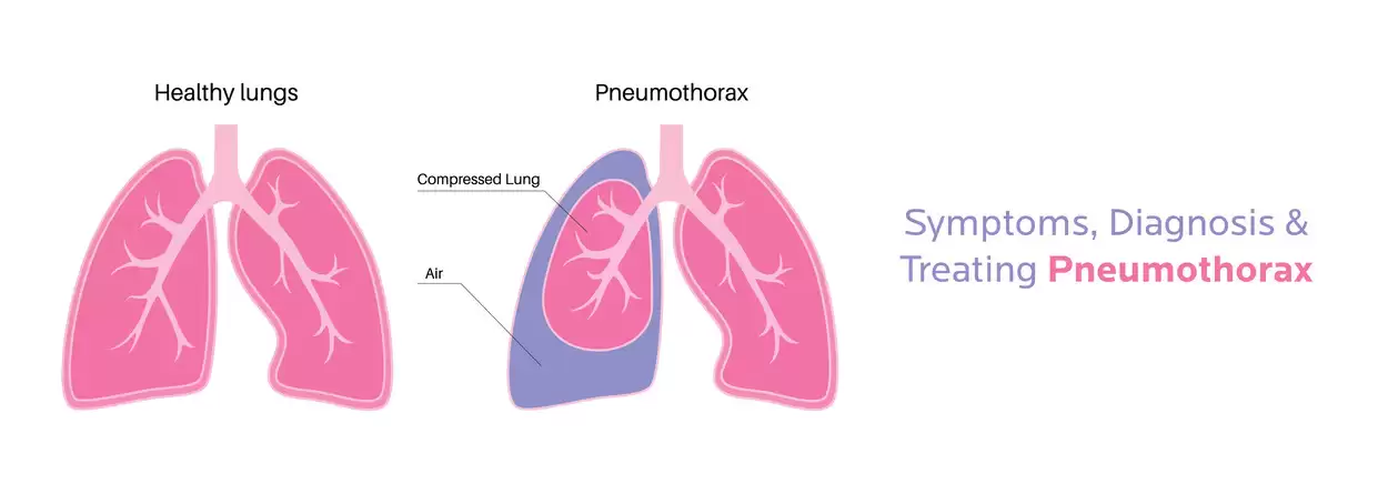 Everything You Need to Know About Pneumothorax