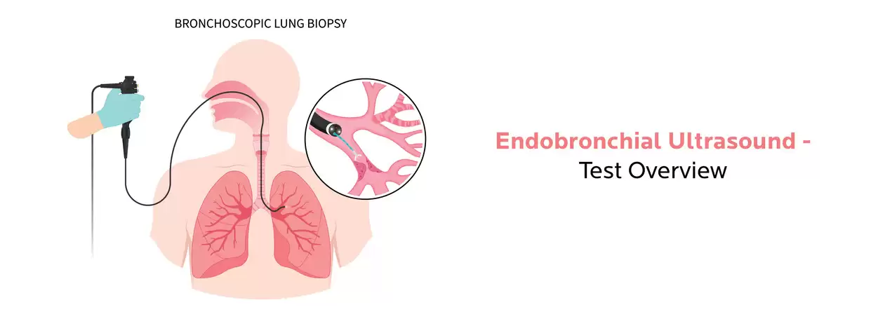 What All You Need to Know About Endobronchial Ultrasound